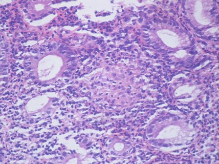 Figure 3: Photomicrograph showing granulomatous gastritis with epitheloid giant cells (H and E X400).